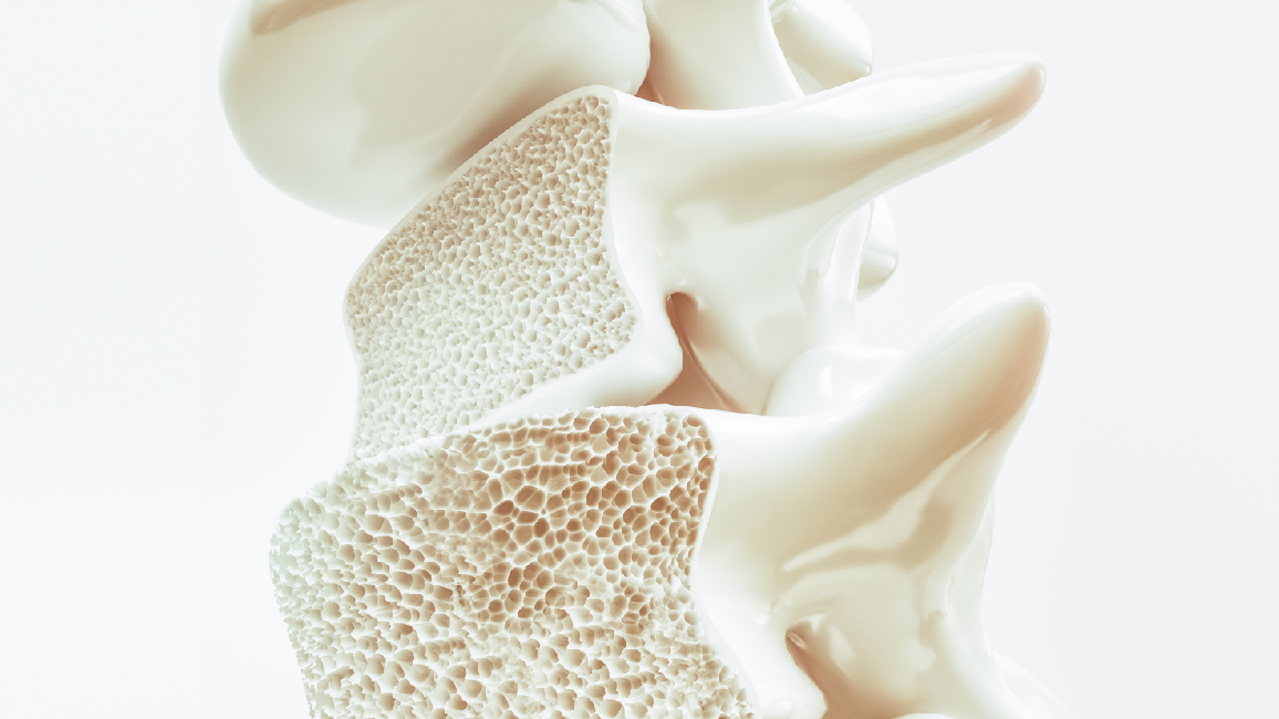 Osteoporosis Don't wait for the line to start preventing it at a young age.